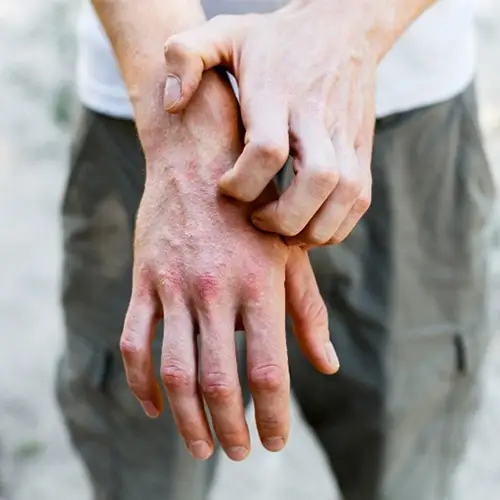Person with very dry, chapped hands